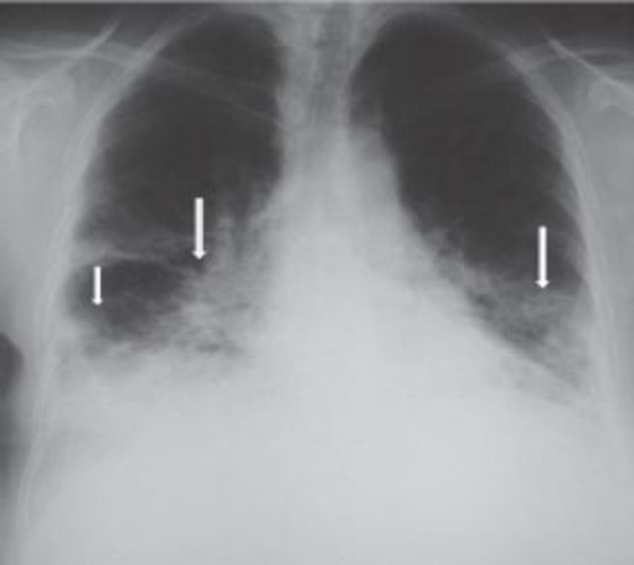 saddle pulmonary embolism xray